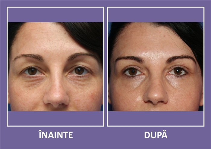 Ai nevoie de operatie estetica in Bucuresti? • Lifting Facial | Chirurgie