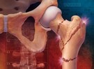 Dieta Atkins predispune la osteoporoza
