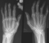 Femeile resimt mai puternic artrita reumatoida