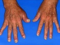 Artrita psoriazica apare la degetele mainilor