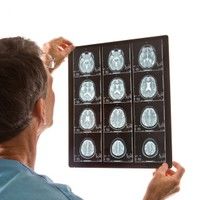 Principalii factori de risc asociati cu atacurile cerebrale