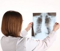 3 simptome care indica prezenta tuberculozei