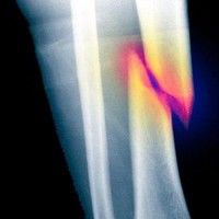 Medicamente pentru osteoporoză care cresc riscul de fracturi