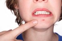 4 tratamente eficiente pentru acnee