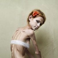 Şocant: Top 10 fotomodele distruse de anorexie
