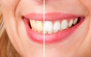 5 secrete despre albirea dentară. Când trebuie făcută?