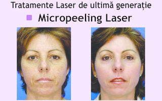 Micropeelingul Laser - tratament de reintinerire a pielii