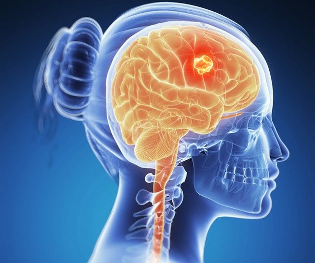 Tumorile cerebrale – simptome, diagnosticare, tratament - Anadolu Medical Center