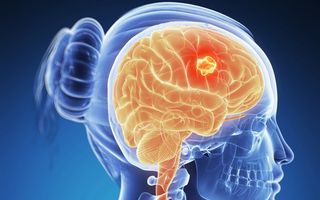 Cancer: 9 simptome provocate de tumorile cerebrale. Nu le ignora!
