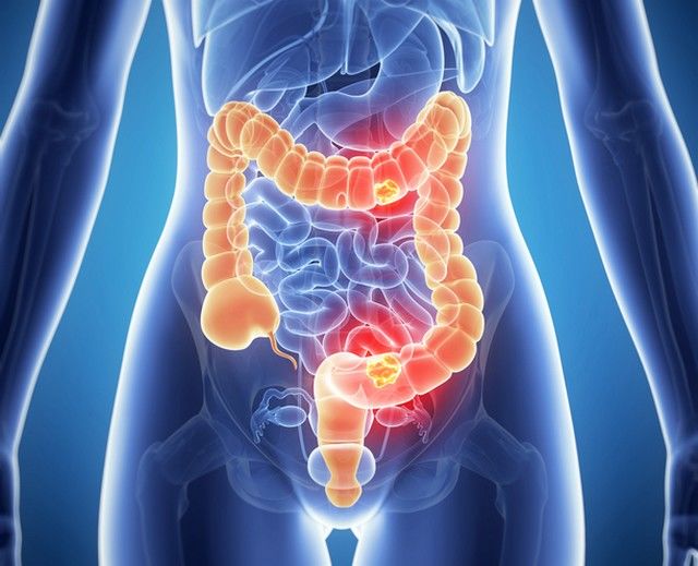Semne și simptome ale cancerului de colon la bărbați