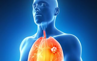 Cancerul pulmonar: 8 cele mai frecvente simptome de care trebuie să ţii seama