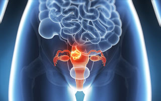 Cancerul ovarian: 5 lucruri pe care trebuie să le cunoşti