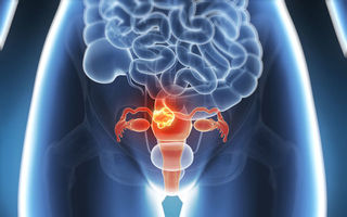 Un nou test medical depistează tratamentul corect pentru cancerul ovarian