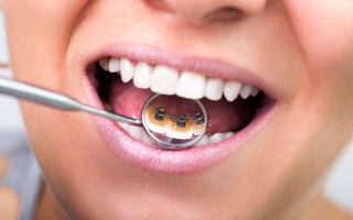 Sănătate. Tot ce trebuie să ştii despre aparatul dentar invizibil