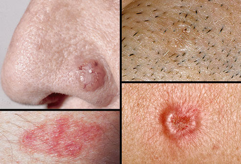 cancerul de piele primele simptome