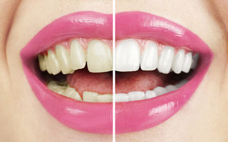 Ţigările afectează dinţii şi gingiile. 5 efecte nocive