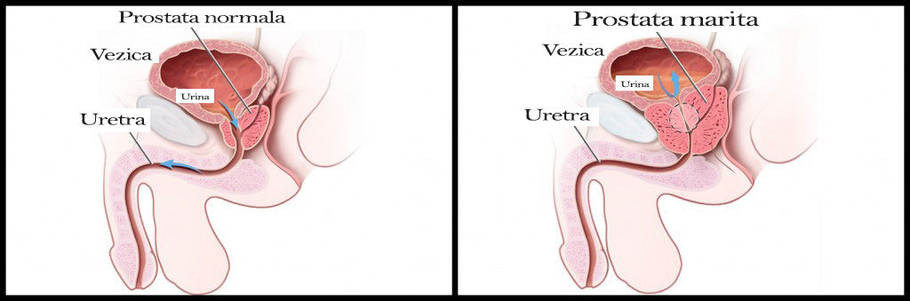 diferența dintre prostatita cronică și adenom)
