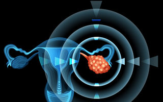 Simptome ale cancerului ovarian pe care multe femei le ignoră