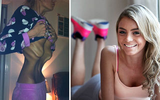Înainte şi după anorexie. 30 de fotografii şocante cu femei care au învins boala