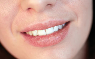 Cum să alegi cea mai bună metodă de albire a dinților?