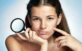 5 lucruri despre acnee pe care poţi să le ignori de acum înainte