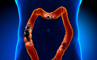 10 factori de risc care favorizează apariţia cancerului la colon