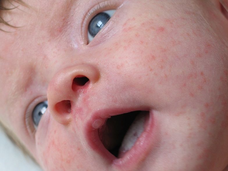 Pleoape umflate la bebeluşi: cauze şi tratament