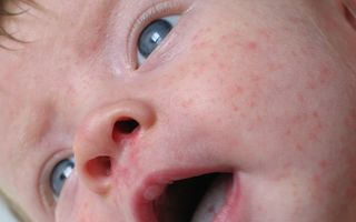 Bubițe roșii pe pielea bebelușului provocate de căldură: cum le tratezi