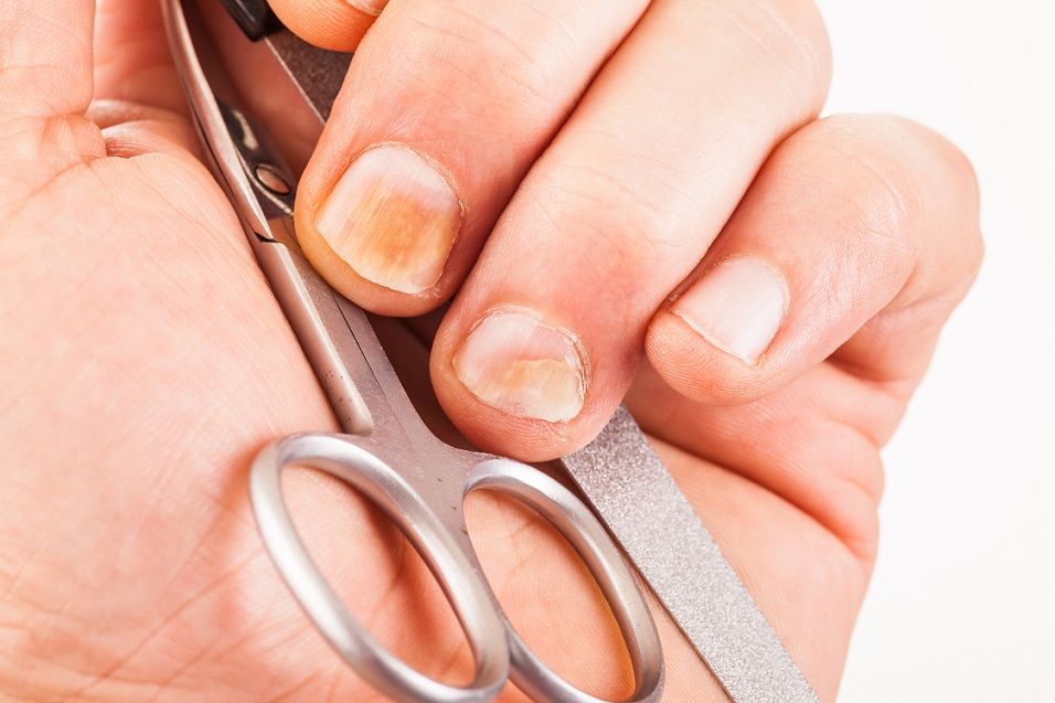 Cum să vindeci unghiile de psoriazis. Psoriazisul plăcii unghiei: cum să faceți față problemei