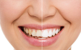 5 cauze pentru îngălbenirea dinților