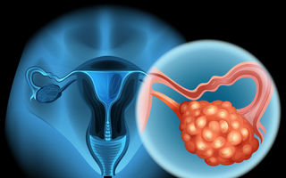 4 simptome timpurii ale cancerului ovarian pe care orice femeie trebuie să le știe