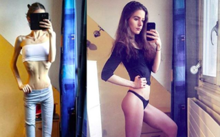 Înainte și după anorexie. O poveste înduioșătoare care demonstrează că poți să câștigi lupta