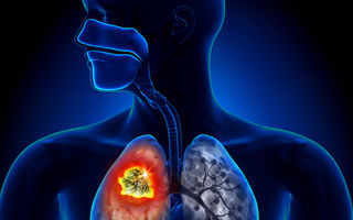 Studiu. Pacienții cu cancer pulmonar trăiesc mai mult dacă sunt tratați cu imunoterapie