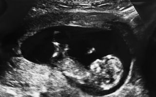 Povestea femeii care a rămas însărcinată în timp ce era deja gravidă