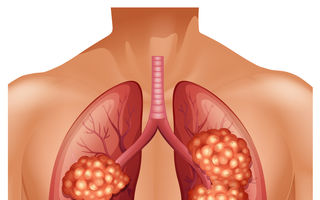 Simptomele cancerului pulmonar (altele decât tusea)