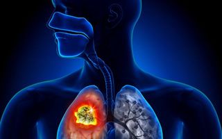75% dintre românii diagnosticați cu o formă de cancer pulmonar ajung la medic în stadiu inoperabil