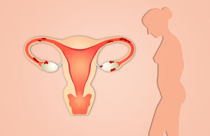 Orgametril Pentru Intarzierea Menstruatiei