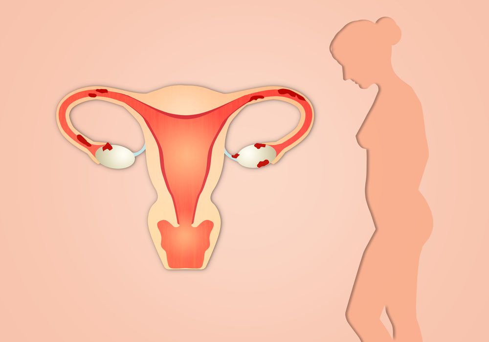 Menstruatie neregulata: ce o provoaca, riscuri si solutii