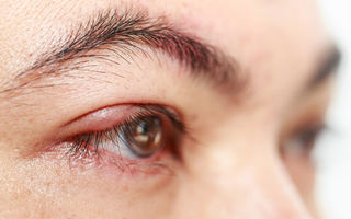 Blefarita - 10 simptome care te trimit la oftalmolog