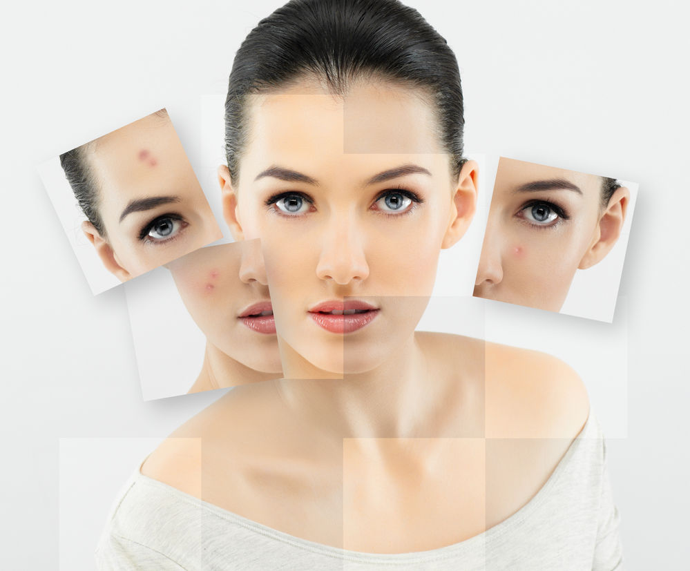 îngrijirea pielii anti-îmbătrânire care combate acneea