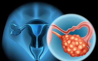 Ce ar trebui să știi despre cancerul ovarian