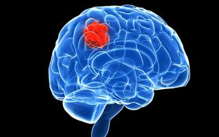 Semne care te ajută să descoperi tumorile cerebrale înainte de a fi prea târziu și să nu amâni vizita la medic