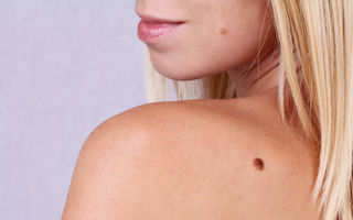 Protejează-te de cancerul de piele în mod corect: 7 mituri despre alunițe pe care să nu le crezi