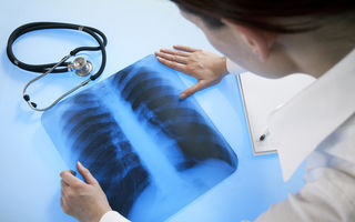Postarea virală a unui medic care a comparat 3 radiografii: Plămânii unei persoane post-COVID sunt mai afectați decât ai unui fumător înrăit