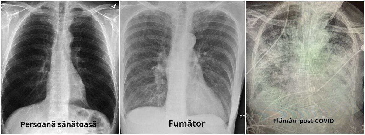 radiografie pulmonara plamani sanatosi