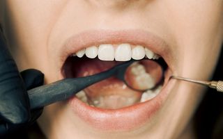 Întărirea gingiilor. Șase metode care nu dau greș