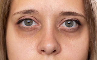 Remedii naturale pentru cearcăne și pungile de sub ochi