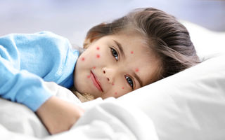 Varicela: ce trebuie să știi despre boala copilăriei – simptome, tratament și recomandări