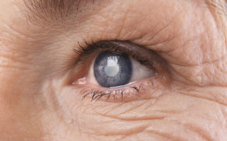 Cum îți dai seama că ai cataractă? Semne timpurii pe care să nu le ignori