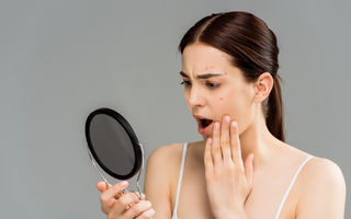 Acneea la vârsta adultă: de ce reapare și cum o putem gestiona fără vinovăție